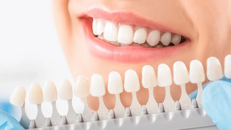 Strahlen weiße Zähne mit Bleaching (Zahnaufhellung)